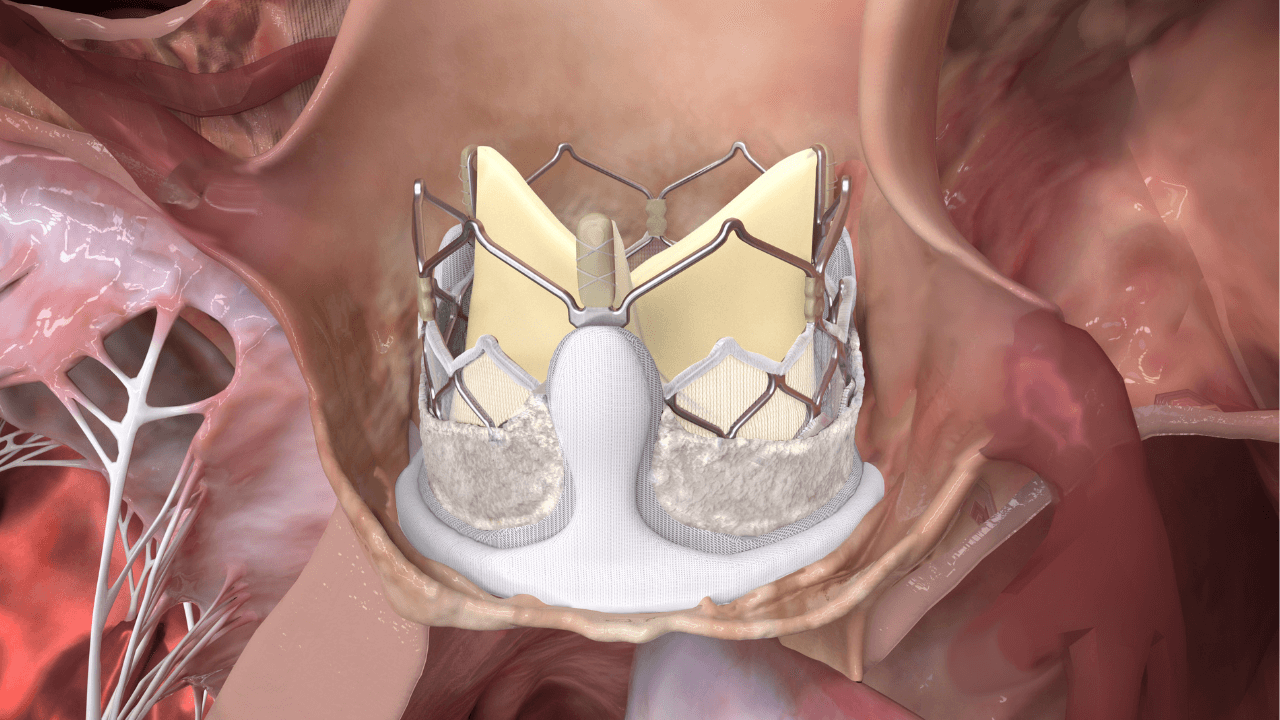 Update on DurAVR® THV Valve-in-Valve Experience